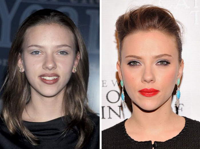 Scarlett Johansson - Cosmetic Surgeries